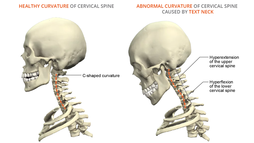 text neck - healthy neck - comparison - spine - anatomy