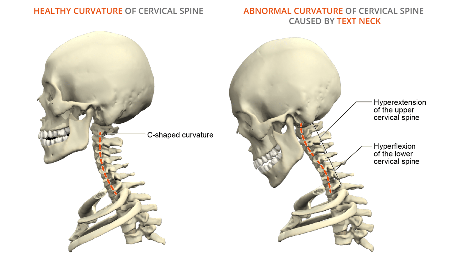 Text Neck Anatomy of a Modern Spine Condition