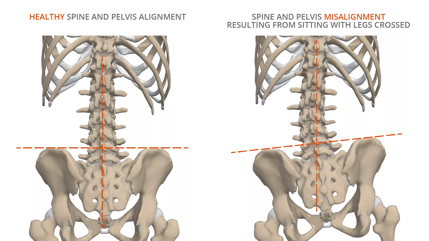 pelvis - spine - misalignment - alignment - anatomy - cross-legged - legs - crossed - Primal Pictures