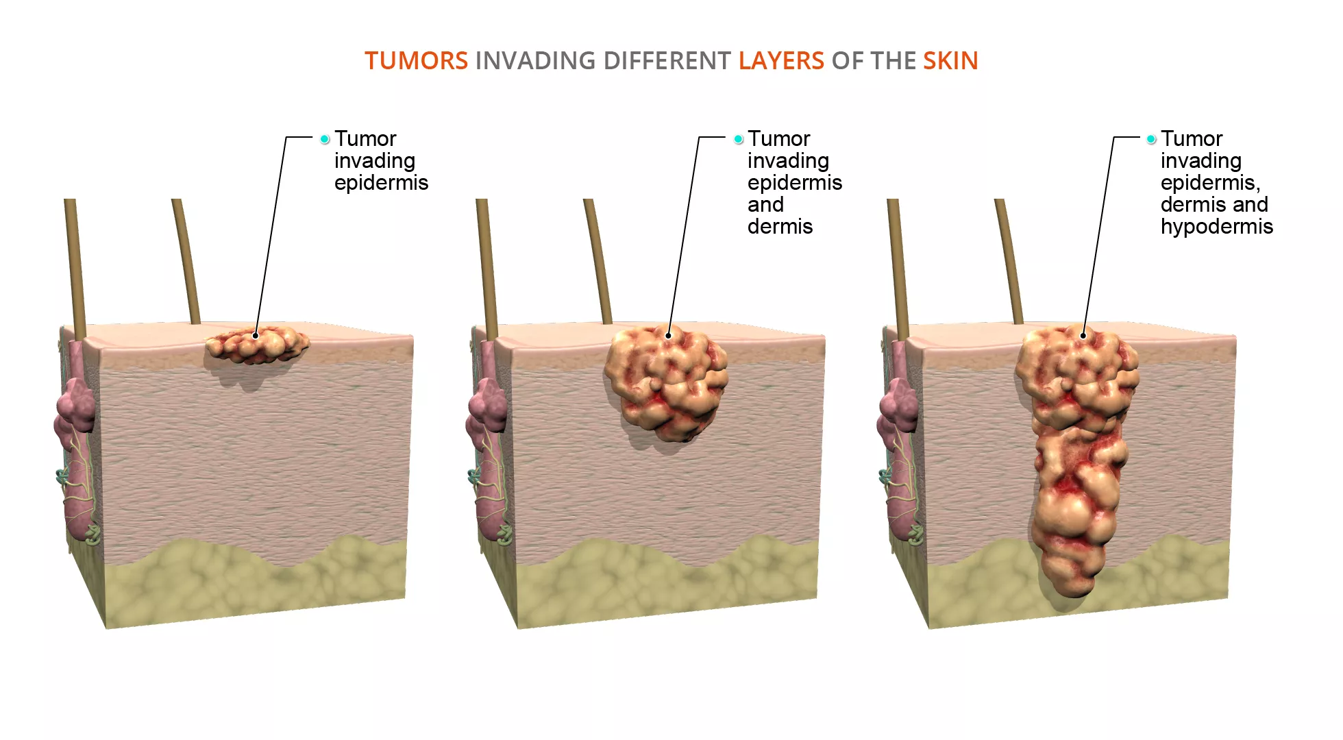 skin - cancer - anatomy - Primal Pictures