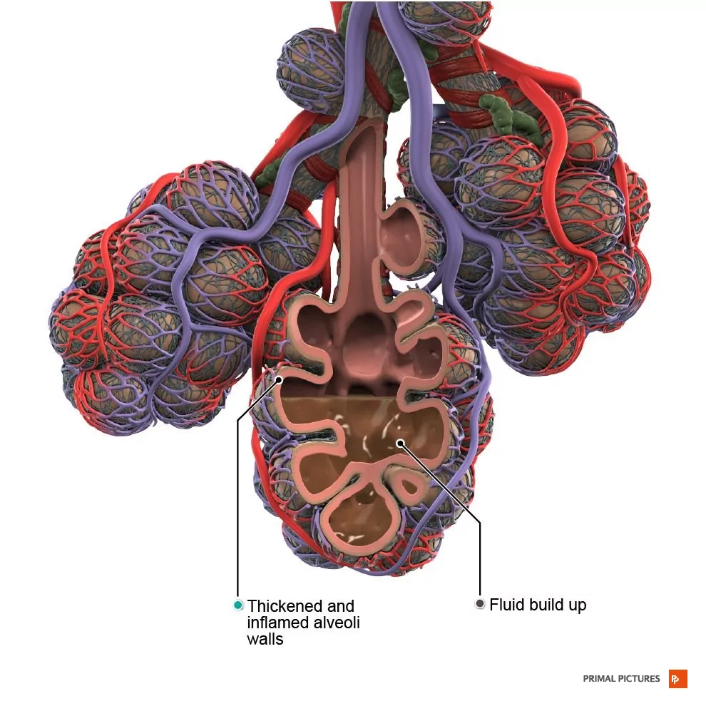 Tobacco Effects On The Lungs